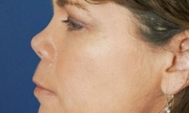 Курносый нос